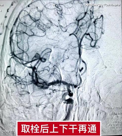 抢抓黄金救治时间  疏通血管为生命续航(图2)